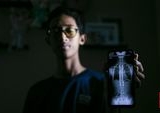 Kisah Inspiratif Refan: Bangkit Melawan Skoliosis Lewat Operasi Implan Titanium