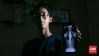 Kisah Inspiratif Refan: Bangkit Melawan Skoliosis Lewat Operasi Implan Titanium