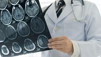 Waspada! Studi Ungkap Golongan Darah A Berisiko Lebih Tinggi Terkena Stroke Usia Muda